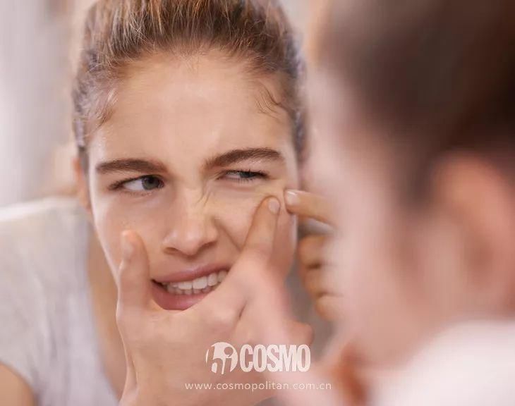 美人计 | 告别烂脸，油皮痘痘肌夏天怎么过