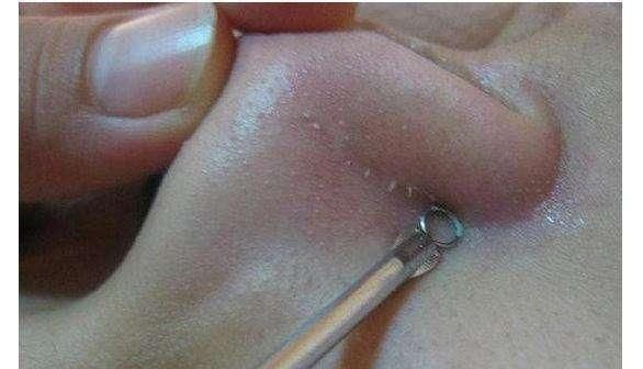 毛孔里反反复复挤出的小米粒，属于螨虫黑头，陨灭螨虫只需2招