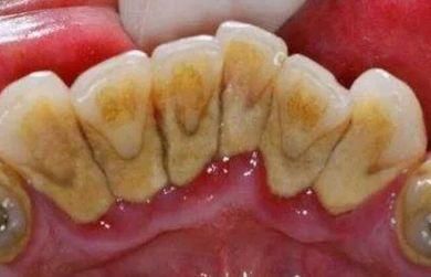  『不用』“牙结石”教你4个土办法，不用去洗牙，牙垢哗哗往下掉