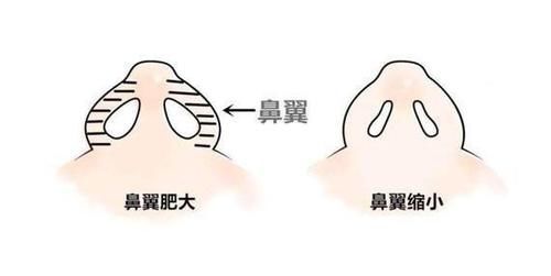  鼻翼基底|只做鼻翼缩小可以改善鼻子形态吗？