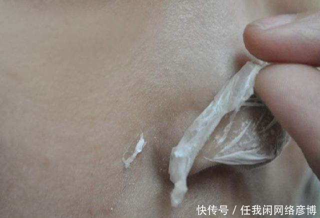 # 黑头#黑头乖乖跑出来，鼻子挤出来的“黄色条物”是啥协和医生教你3招