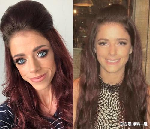 女子为减肥在手臂注射避孕药，最后却患上了厌食症，瘦的皮包骨头