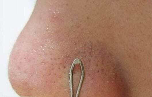 脸上爱长“白色颗粒”,说明上万螨虫挖开毛孔,简单去除只需3招