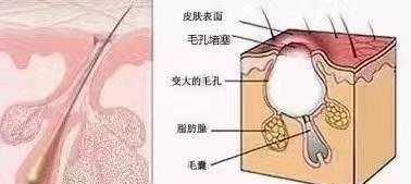  『分泌皮脂』毛孔粗大，有黑头的人怎么护肤？