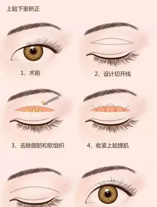  「上睑下垂」除了割双眼皮，还能如何改善自己的眼睛？