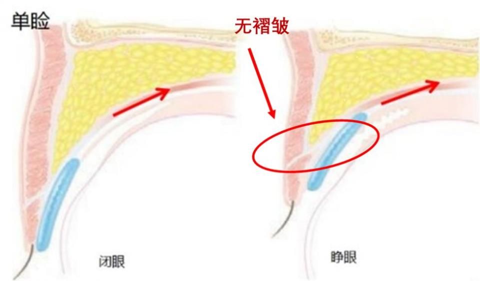 双眼皮“黄金不败宽度”来了!某璐要是早看到也不至于割完眼皮又