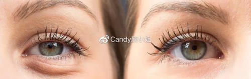  导致@眼袋的危害，不仅仅是显老……
