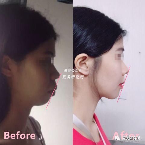 “整牙到底能不能瘦脸”终于有了权威结论，杨幂竟是被冤枉的?