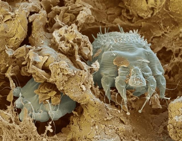 后背有这3个表现，暗示毛孔内螨虫过多，3方法轻松清走“垃圾”