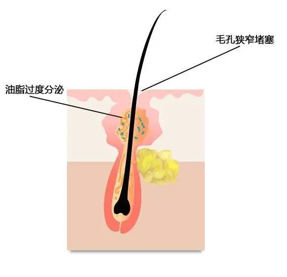 「干性皮肤」别在护肤品上乱花钱了!你连肤质都搞错了