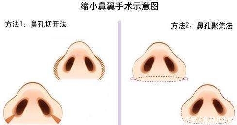  『缩小』鼻翼缩小手术会留疤吗