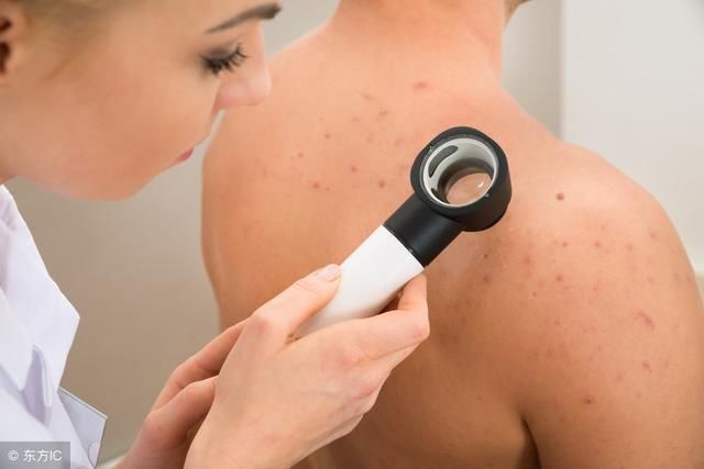 后背的螨虫痘痘越来越严重，是时候除螨了，用这2方法除螨最快！