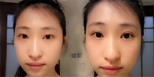 双眼皮是割的还是天生的,看这几点很明显