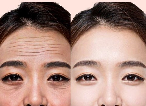 女人有抬头纹无需打玻尿酸，瞧瞧下图女人，药膏抹一抹，纹乖乖走