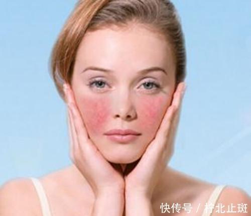泛红@敏感肌最难熬的季节来了,这样护肤,彻底告别干燥泛红和瘙痒