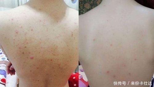  『家里』家里的“硫磺皂”可以直接洗脸？没搞清楚4个作用，难怪痘痘多！