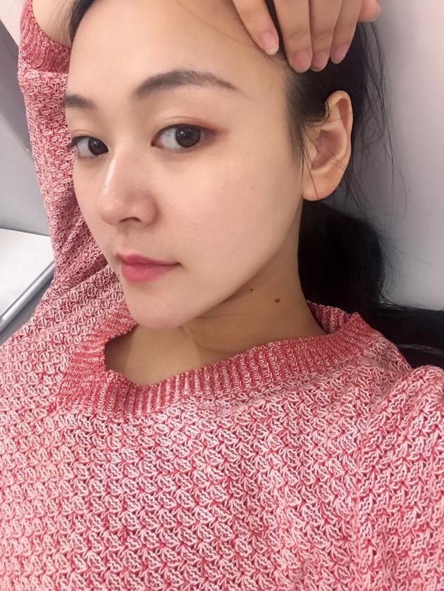 韩式双眼皮+开眼角能做出“桃花眼”吗？这篇真人案例值得参考！