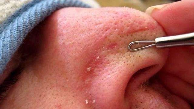 为何黑头总是反复去不掉? 用3招不撕不挤, 黑头粉刺“如雨落下”