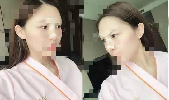 北京艺星割双眼皮确实是对的选择，气质好了