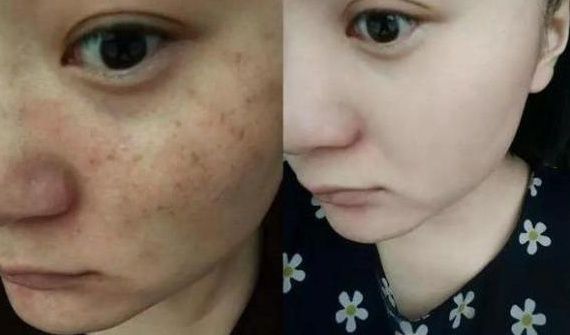 别再傻傻去美容院，祛斑只需一瓶醋，在家随便搞搞三天斑点消失