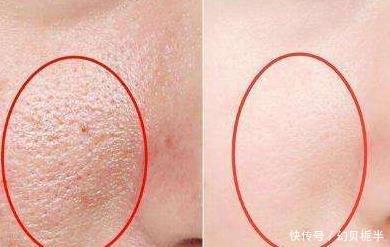  『生活习惯』毛孔粗大很难逆，养成这7个生活习惯，慢慢调理好粗大毛孔