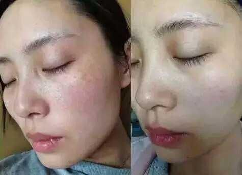 长黄褐斑7年，最后她靠一纸良方成功祛除，究竟是怎么做到的