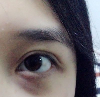 医学院教授透露:睡前涂点药店“便宜乳膏,脂肪粒、眼袋全消