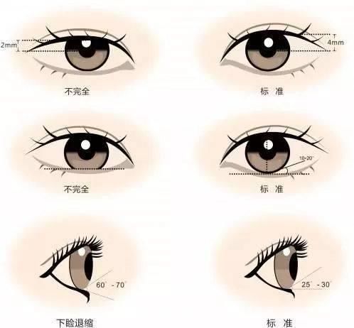  『竟然』什么？你做的双眼皮竟然消失了