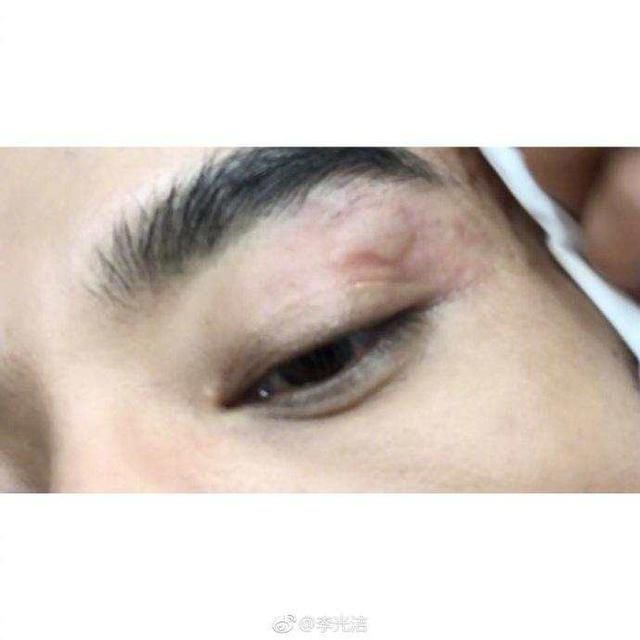 三线男星被蚊子咬,耍大牌停工,称:1个小蚊子可以改变世界?