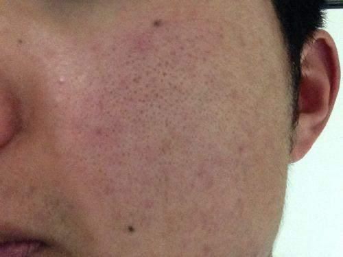 脸上螨虫爆发时有4信号,不除螨,再多护肤品都是在喂养螨虫