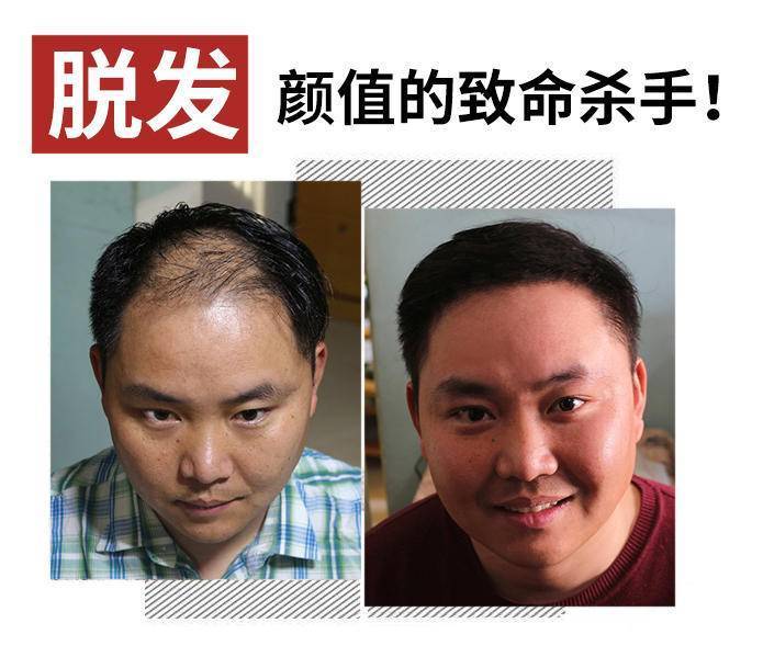 『脱发』先别买买买!剁手前要认清这些让人头秃的真相