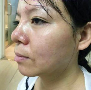 眼角长脂肪粒，跟美容师偷学一招，只需1步，不仅快效果还不疼