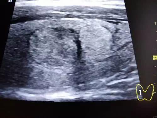 【身心健康】什么是甲状腺腺瘤、囊肿？