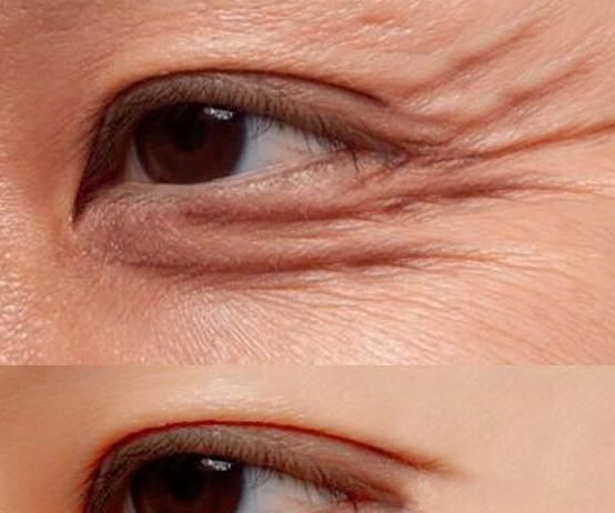 「眼部皮肤」有哪些去细纹的眼霜?