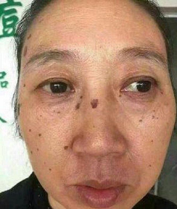 长出“老年斑”别慌张，用了药店的“小药膏”斑不见了脸也变白了