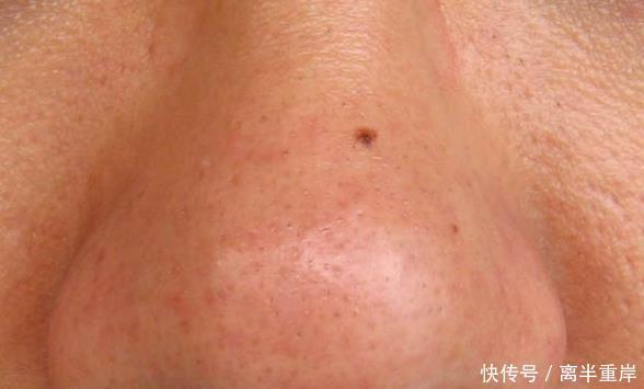 #去除黑头#皮肤科医生:这4物去黑头,坚持个把月,黑头就好很多