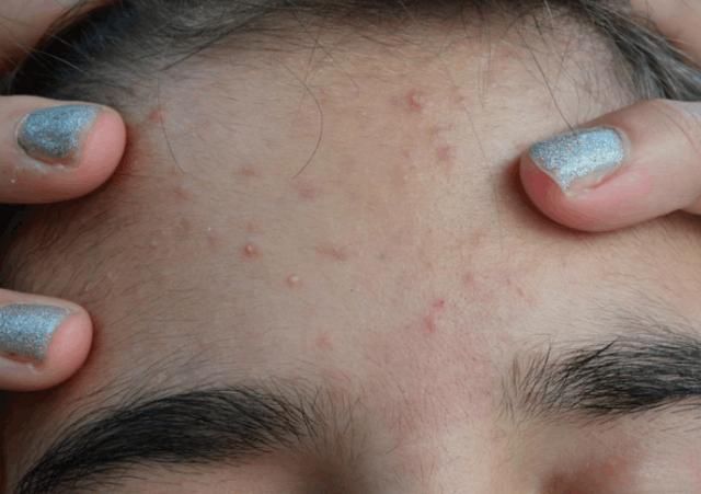 起床后有这3个问题的，说明是螨虫在毛孔里“工作”一整夜的成果