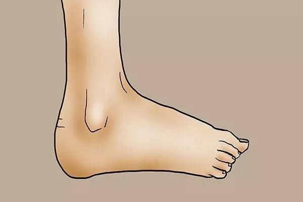 茧子:脚部又硬又黄,是怎么回事?如何去除脚上的茧子?