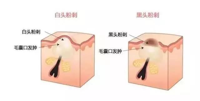 开口闭口粉刺，识别黑头白头……了解这些你冒痘的脸还有得救！