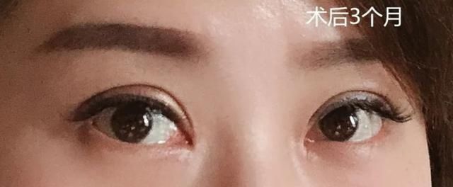  【识破】割的双眼皮会被“一秒识破”吗？最怕空气突然安静！