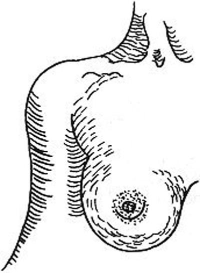 #手术#求美者对于假体隆胸手术切口该如何选择呢?