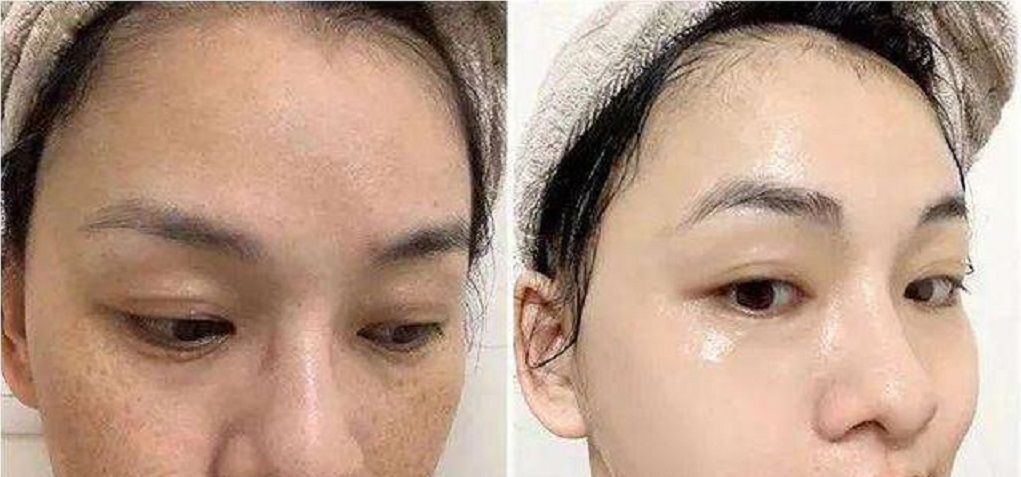  『方法』听说用香菜煮的水洗脸可以祛脸上的雀斑,是真的吗?
