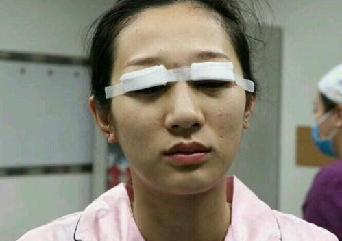 切开双眼皮真实案例分享，眼睛变大变有神了