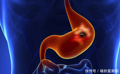 胃溃疡吃什么调理?分享4种食物助你修复胃黏