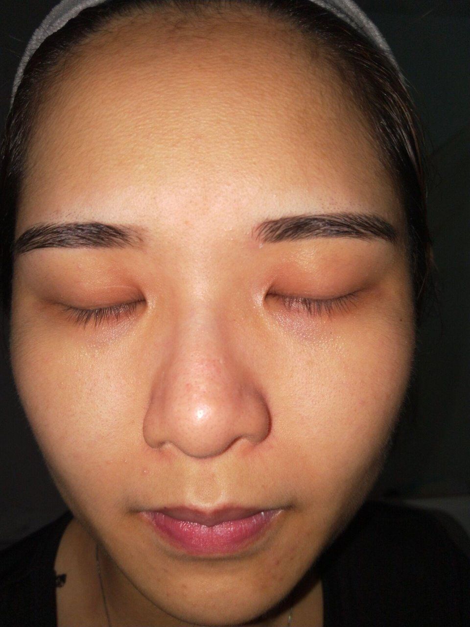 如何去除“闭口粉刺”