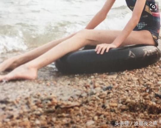 女孩拥有1.2米的大长腿，却无法像平常女孩一样，穿裙子穿高跟鞋