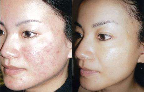 脸上的痘痘没了,留下痘印痘坑怎么办呢?