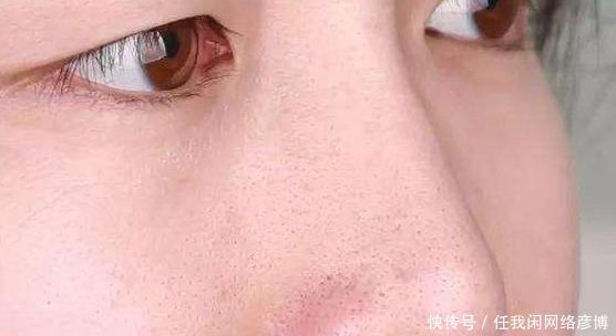 # 黑头#黑头乖乖跑出来，鼻子挤出来的“黄色条物”是啥协和医生教你3招