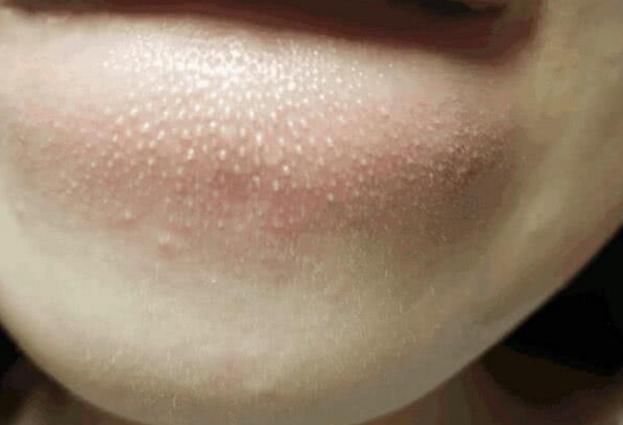 下巴出现这样的‘小痘痘’千万要注意，这是螨虫的真身吗？
