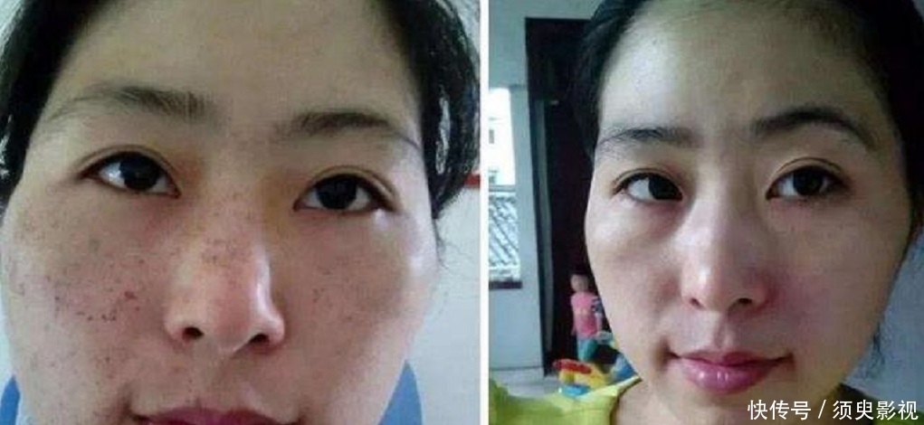  【脸部】牙膏加“它”涂抹脸部，一周只需两三次，15天下来淡化色斑又嫩肤